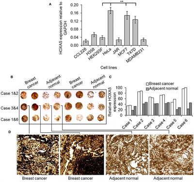 HOXA5 Expression Is Elevated in Breast Cancer and Is Transcriptionally Regulated by Estradiol